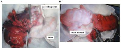 High Ligation of the Inferior Mesenteric Artery Induces Hypoperfusion of the Sigmoid Colon Stump During Anterior Resection